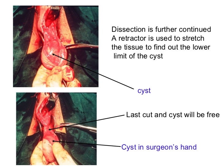 surgery for vaginal cysts Teen bys masterbating